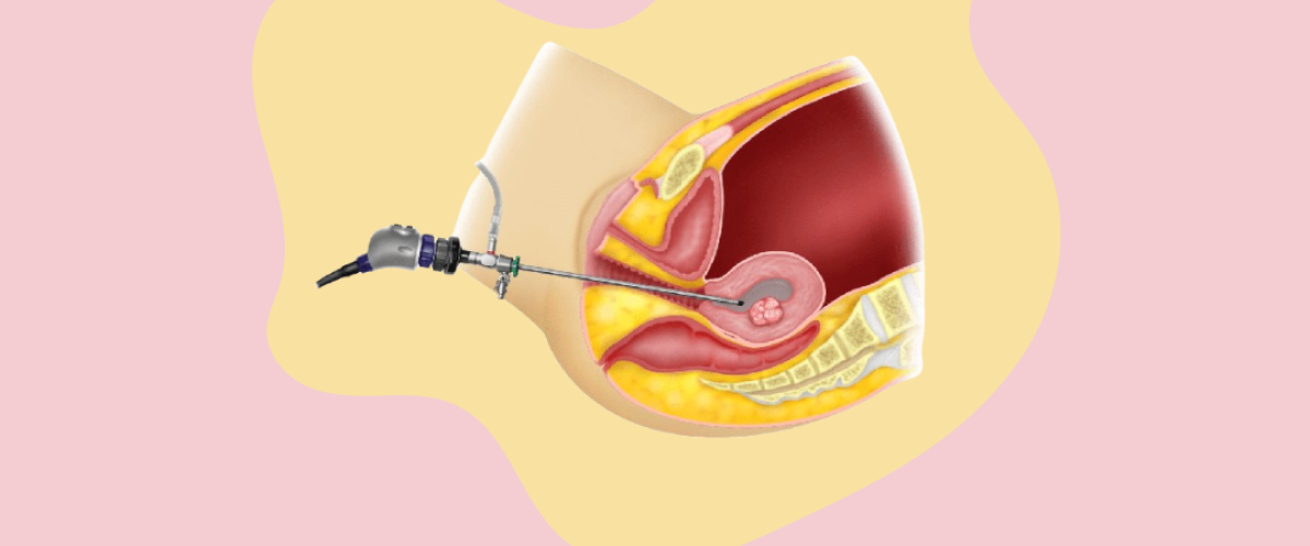 Hysteroscopy